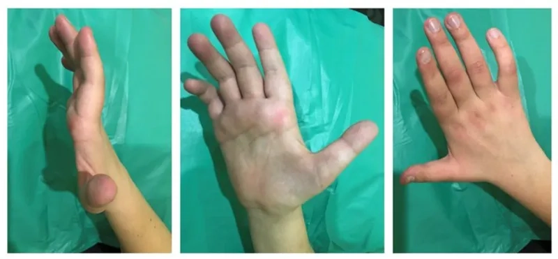 Decompression surgery for Chiari malformation