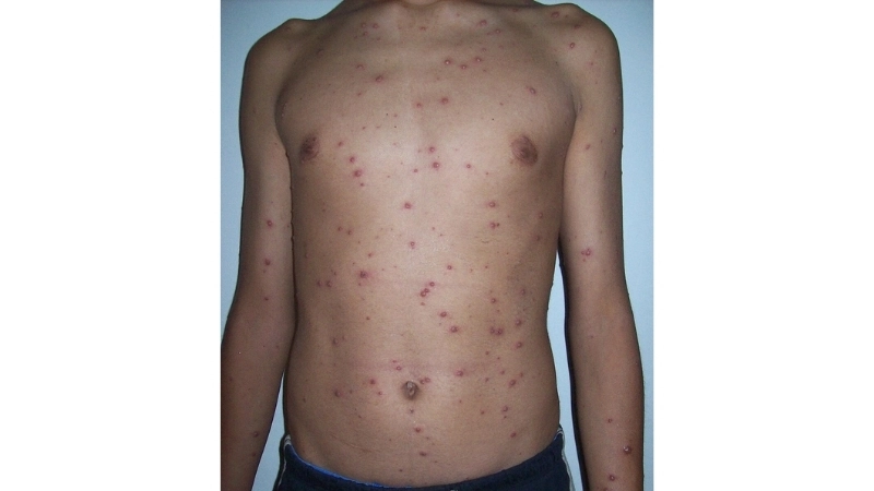 Chickenpox symptoms with Chickenpox