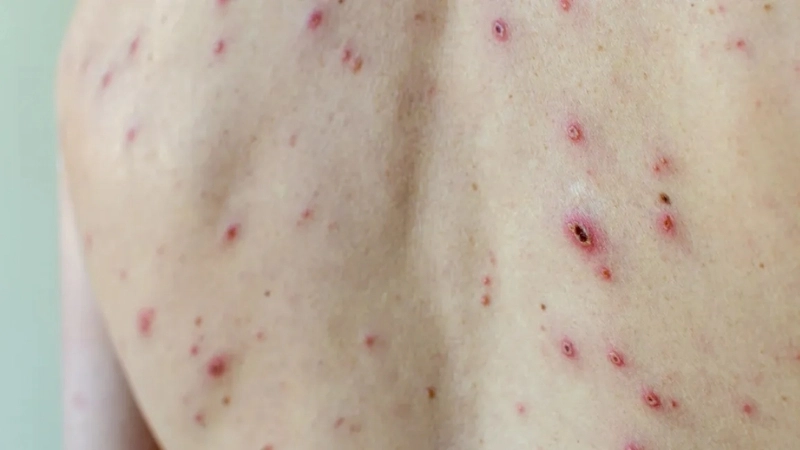 Chickenpox in adults with Chickenpox