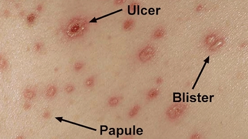 Chickenpox treatment for Chickenpox