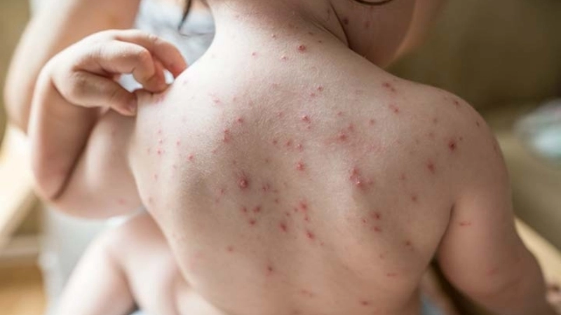 How to get Chickenpox easily Chickenpox