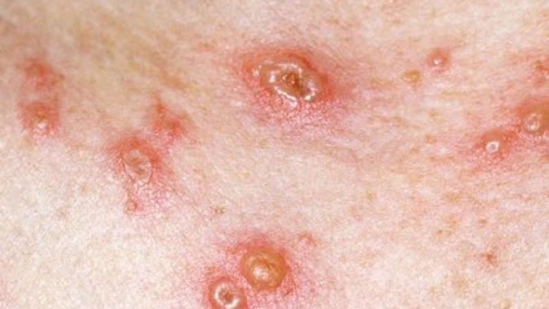 Is Chickenpox contagious answer Chickenpox