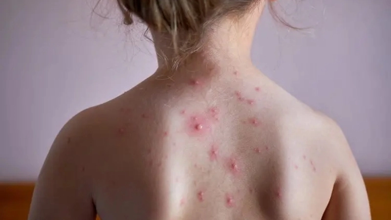 Chickenpox pictures show real Chickenpox