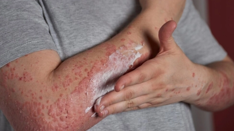 Shingles vs Chickenpox clear Chickenpox