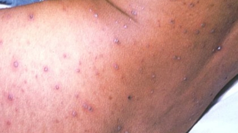 Chickenpox on scalp shows Chickenpox