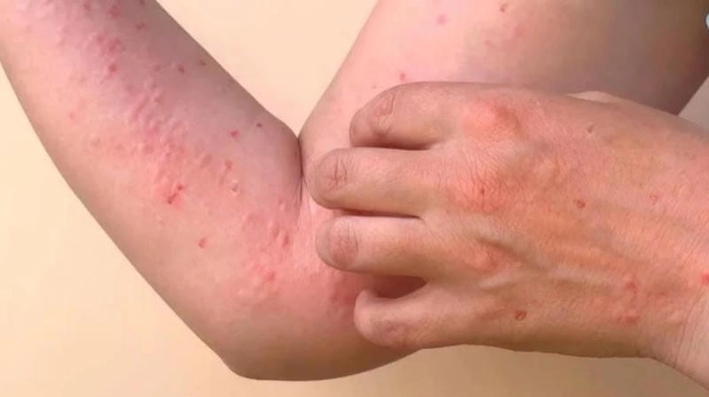 Comparing the symptoms of Chikungunya versus Dengue fever