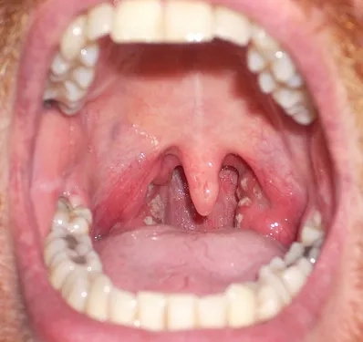 Chlamydia treatment antibiotics prescribed by a healthcare provider