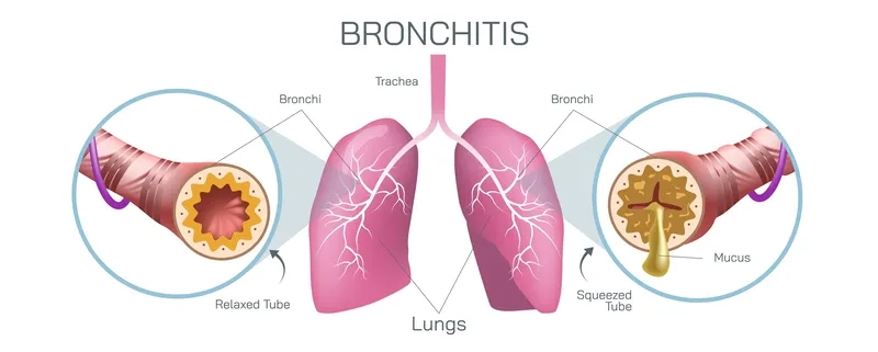 Early chronic bronchitis symptoms awareness