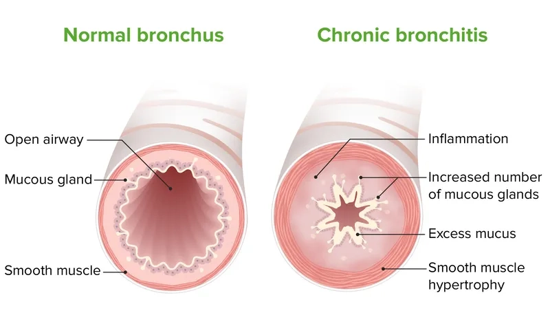 Is chronic bronchitis curable explained visually