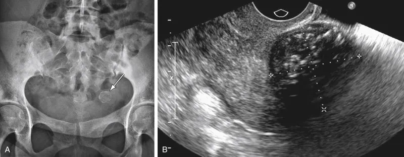 Nerve pain illustration of pudendal neuralgia disorder
