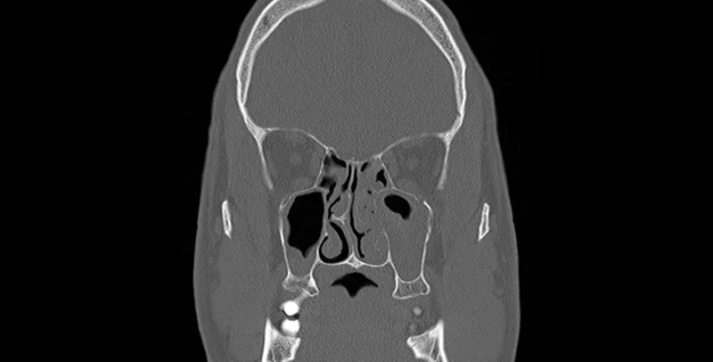 Patient experiencing sinus headache discomfort