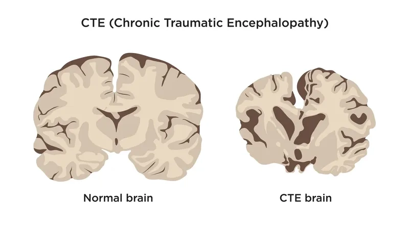 A brain scan comparison illustrating what is CTE