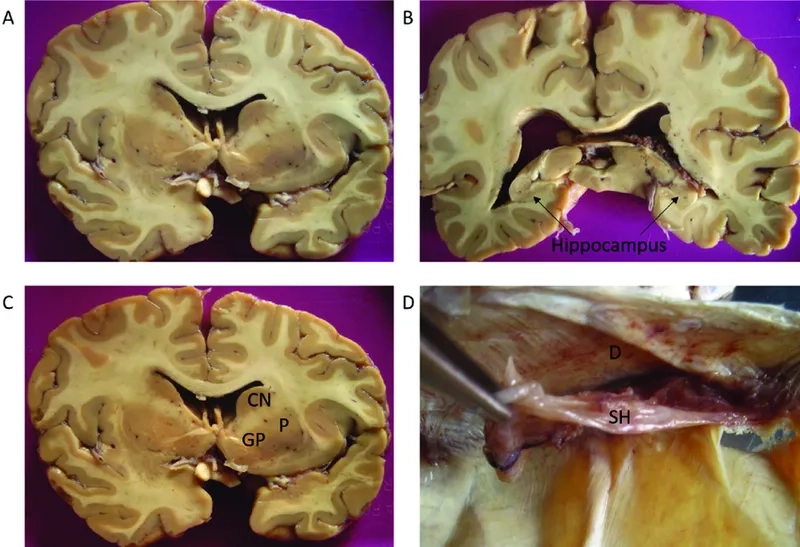 A portrait of a former athlete discussing CTE in football players