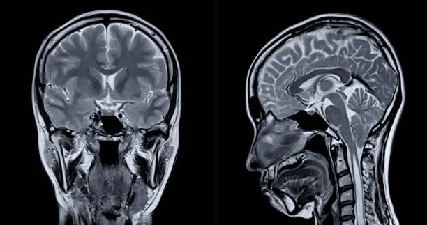 Key signs of CTE to watch for in loved ones