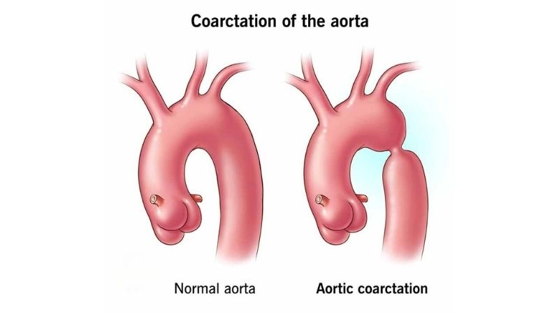 Coarctation of the aorta diagnosis early detection is essential