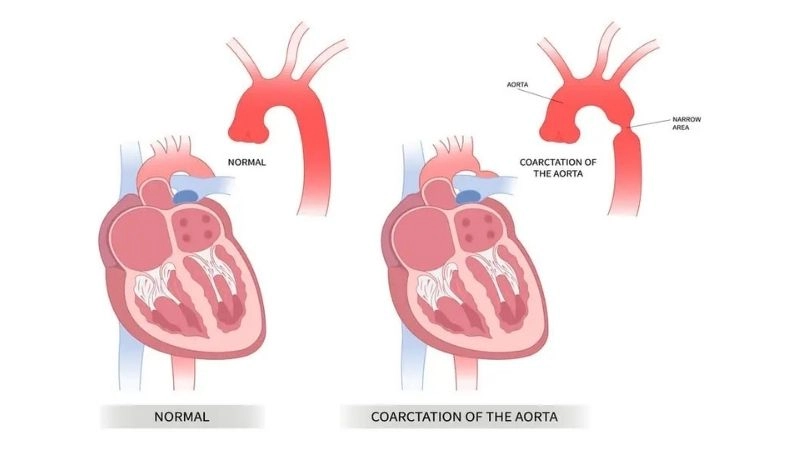 Coarctation of the aorta treatment options to improve blood flow