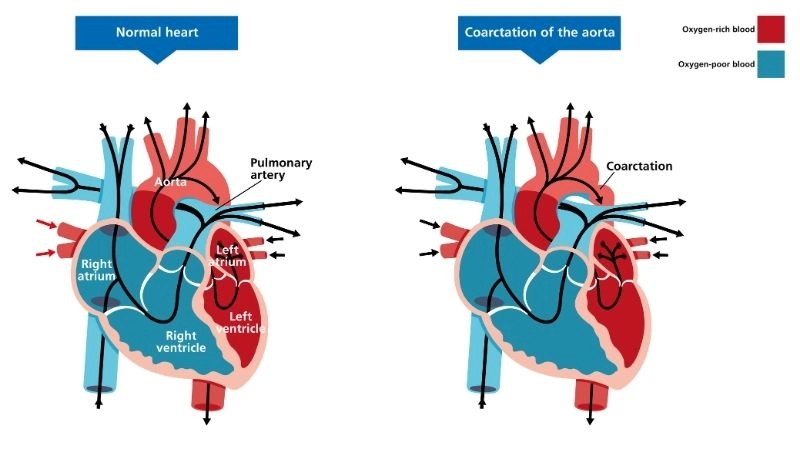 Coarctation of the aorta surgery repairing the narrowed aorta