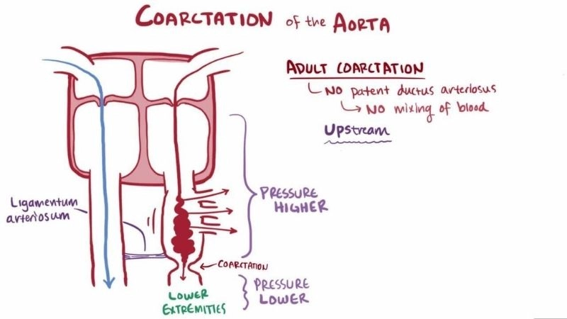 Coarctation of the aorta in adults late diagnosis and risks