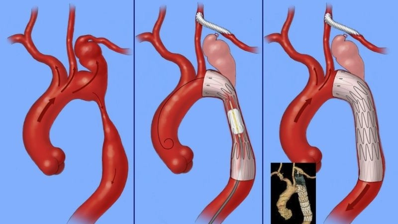 Coarctation of the aorta repair restoring normal circulation