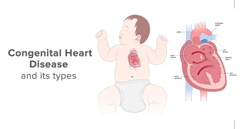 An illustration of a congenital heart defect