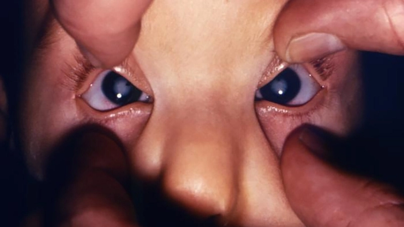 Congenital Rubella Syndrome CRS treatment info