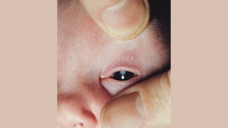 Congenital Rubella Syndrome rubella rash explained