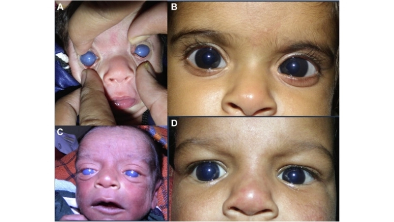 Congenital Rubella Syndrome CRS symptoms guide