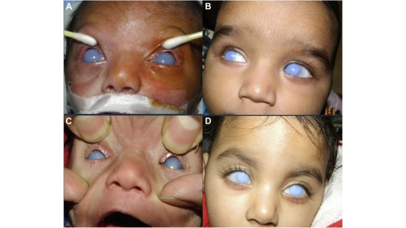 Congenital Rubella Syndrome diagnosis details