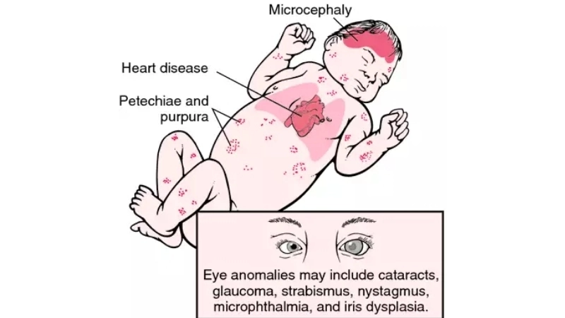 Congenital Rubella Syndrome prevention tips