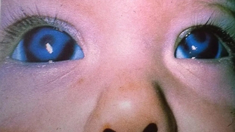 Congenital Rubella Syndrome rubella in pregnancy