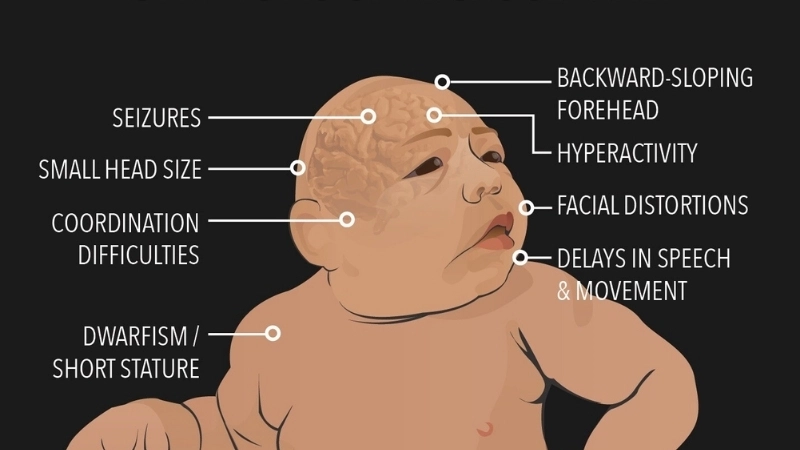 Congenital Zika Syndrome risks in Zika pregnancy