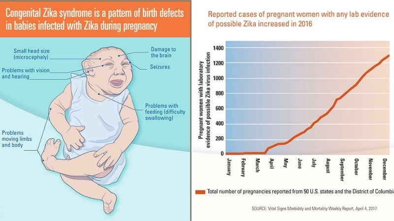 Congenital Zika Syndrome causes Zika birth defects