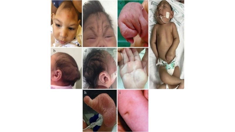 Congenital Zika Syndrome tied with Zika symptoms