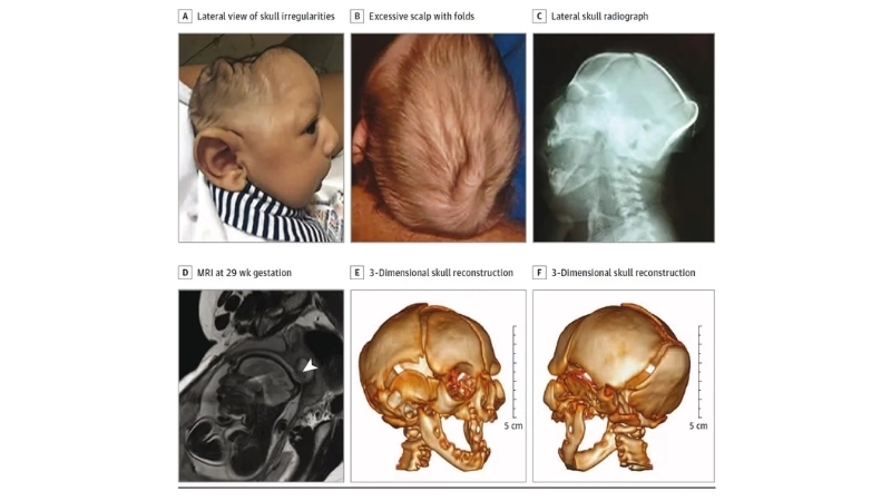 Congenital Zika Syndrome leads to microcephaly