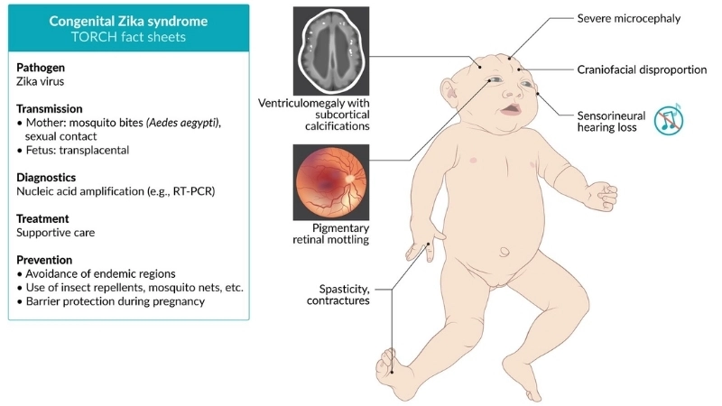 Congenital Zika Syndrome focus on Zika prevention