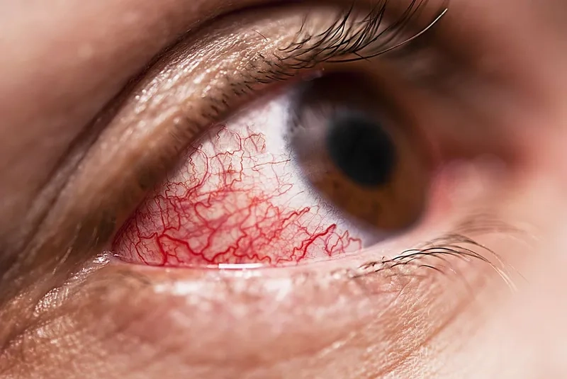 How to get rid of pink eye fast with proper care