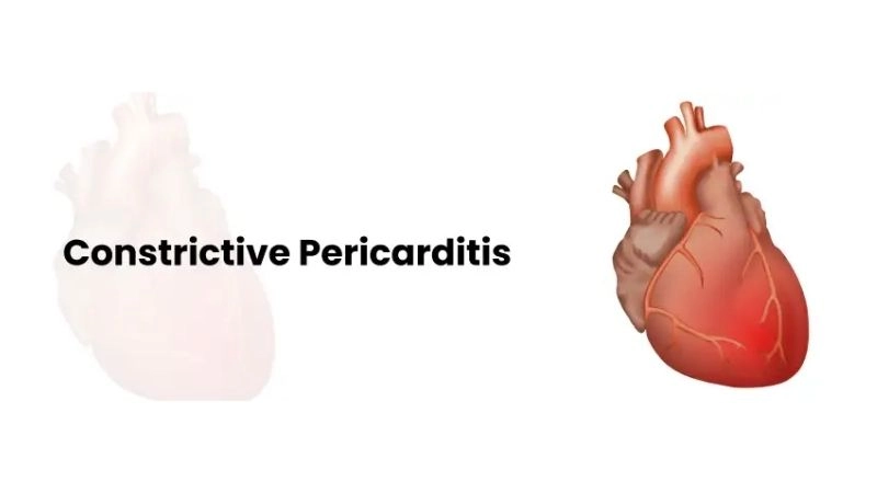 Constrictive pericarditis symptoms warning signs of heart restriction
