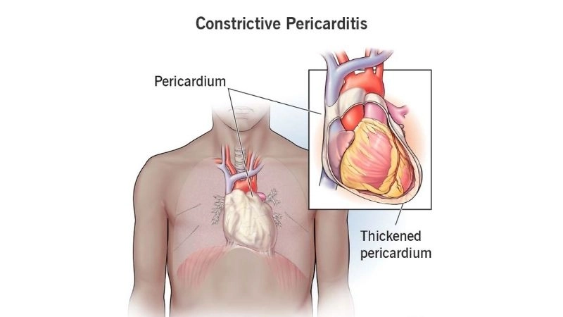 Constrictive pericarditis diagnosis accurate detection of condition