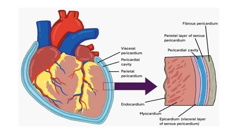 Pericardiectomy for constrictive pericarditis definitive surgical cure