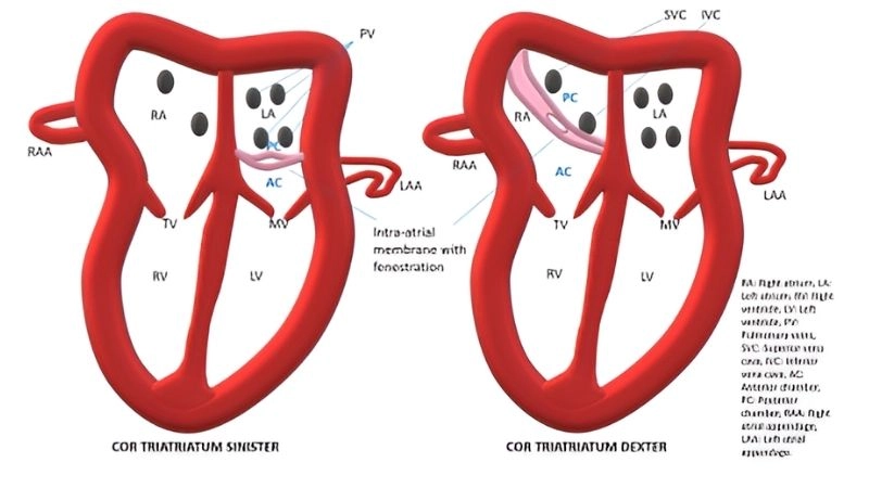 Cor triatriatum diagnosis accurate detection of heart defect