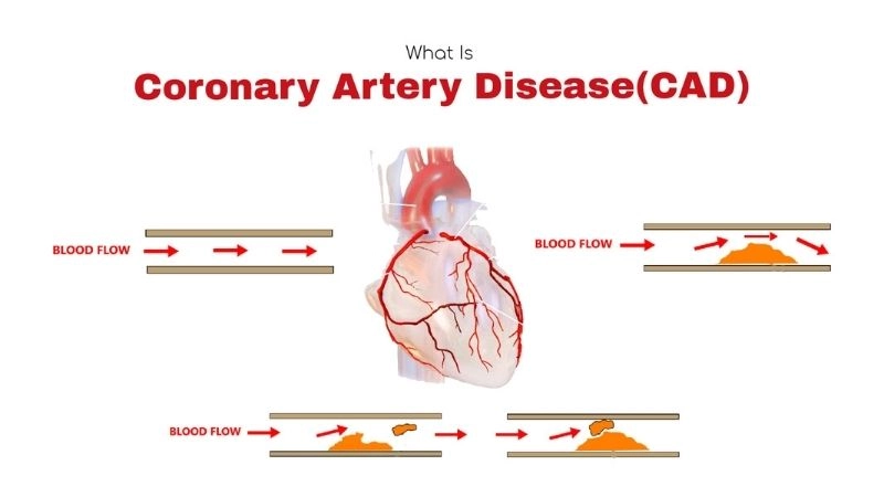 Early warning signs of coronary artery disease symptoms