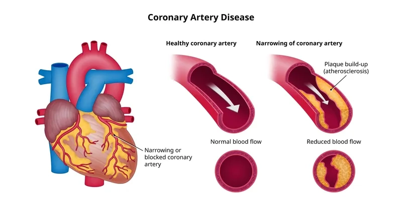 Coronary artery disease symptoms affecting heart health