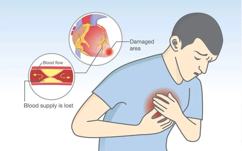 Coronary artery disease prevention with lifestyle care