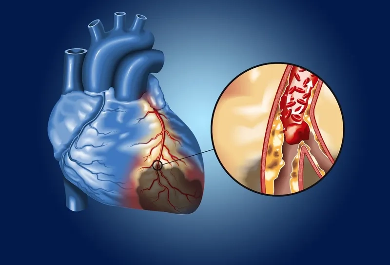 Signs of blocked arteries requiring medical care