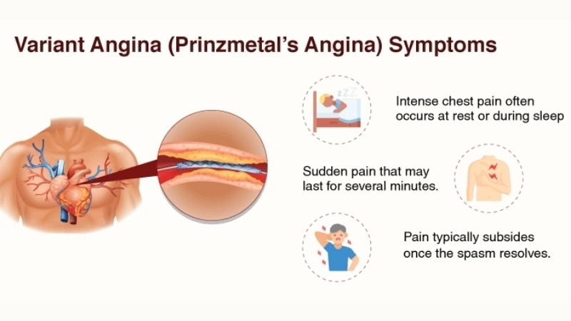Accurate steps in prinzmetals angina diagnosis