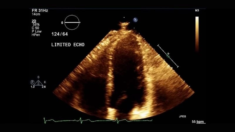 Key prinzmetals angina triggers identified