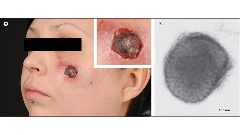 Cowpox symptoms show early signs