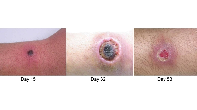 Cowpox treatment helps recovery