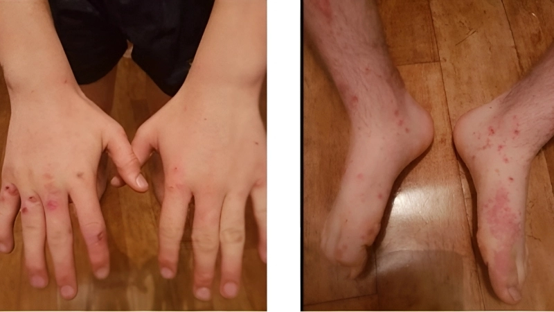 Cowpox vaccine offers protection