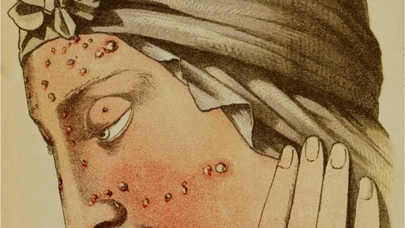 Cowpox vs smallpox shows key facts